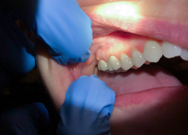 Best Urgent Care for Lost Fillings or Crowns in Harleysville, PA